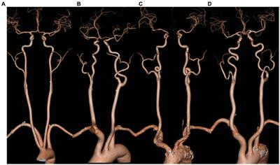 Age and duration of hypertension are associated with carotid artery tortuosity